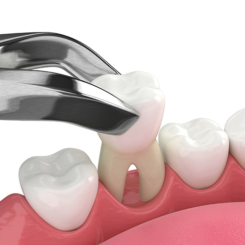Illustration of a tooth extraction