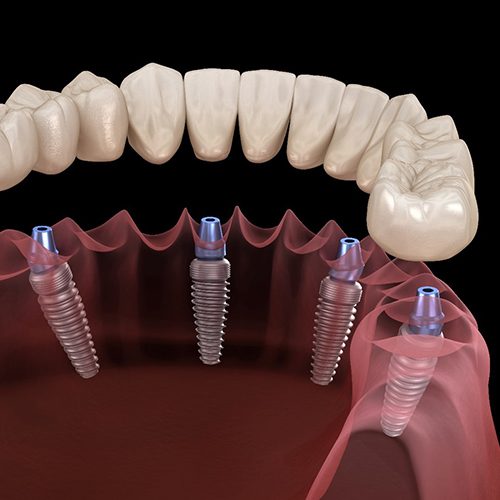 FAQs about dental implants in North Naples.