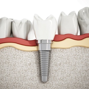 3D illustration of a dental implant, abutment, and crown