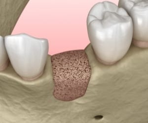 Animated smile with bone graft in place