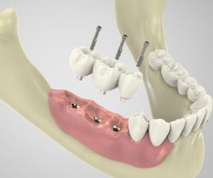 3 D animated dental implant placement surgery