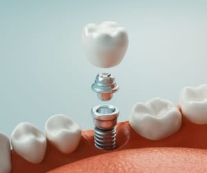 Animated immediate dental implant placement