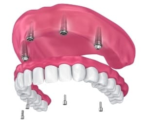 Animated immediate load denture placement