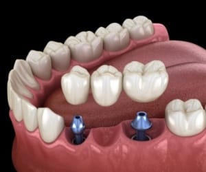 Animated dental implant supported fixed bridge