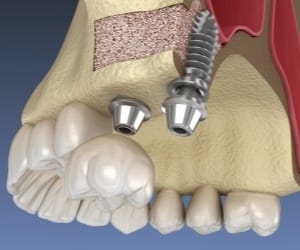 Animated dental implant placement following sinus lift procedure