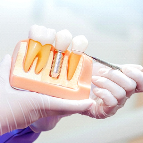 Using model to explain mini dental implants in North Naples vs. traditional implants