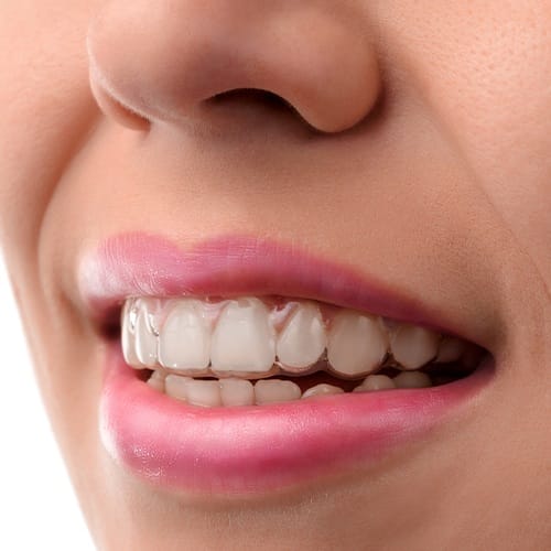 Smile with Invisalign clear braces in place