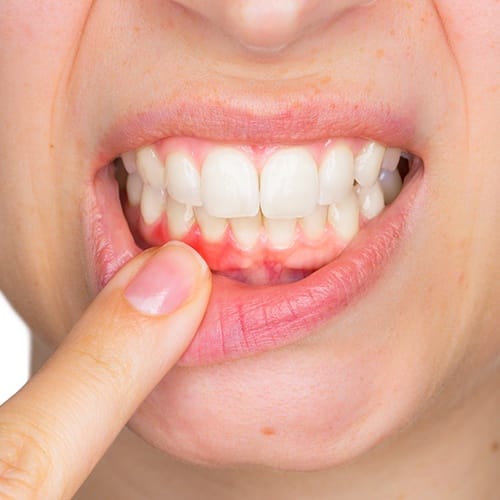 Patient pointing to damaged gums before periodontal therapy