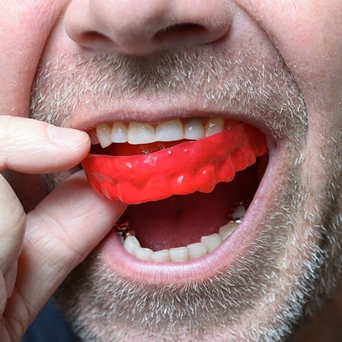 Man placing athletic mouthguard