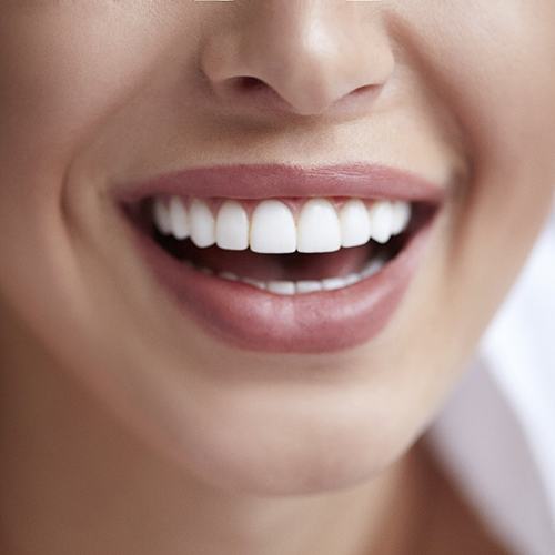 closeup smiling for cost of veneers in North Naples 