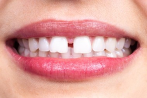a closeup of a smile with a gap between the front teeth