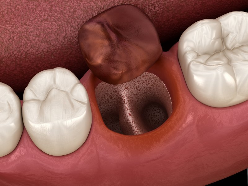digital image of a blood clot dislodging